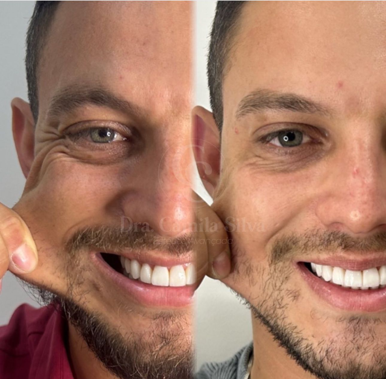 Bioestimuladores de Colágeno