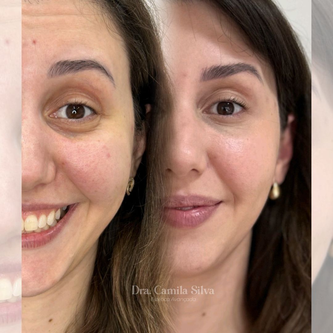 Preenchimento de olheiras