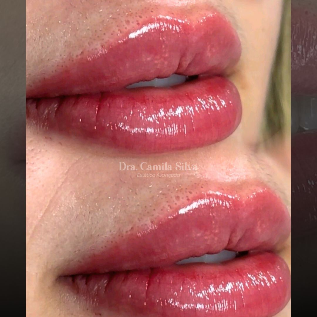Preenchimento labial