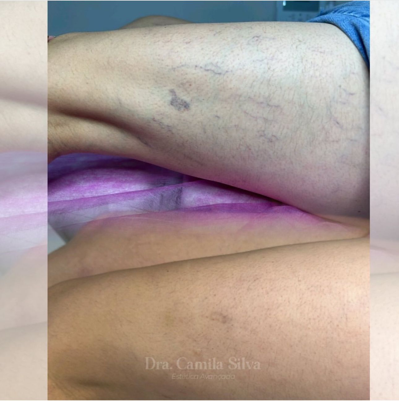 Tratamento para Vasinhos - PEIM